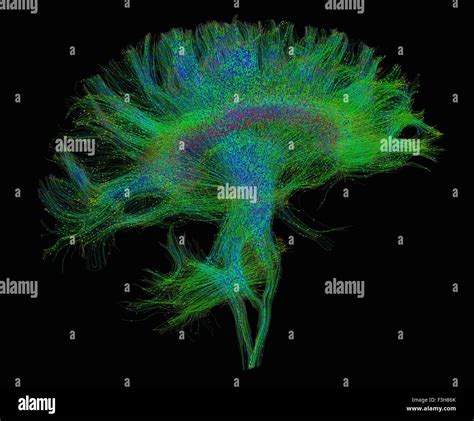 Diffusion Mri Hi Res Stock Photography And Images Alamy