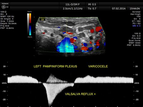 Pampiniform Plexus Ultrasound