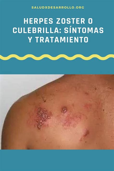 El herpes zoster o culebrilla es una infección vírica ocasionada por el