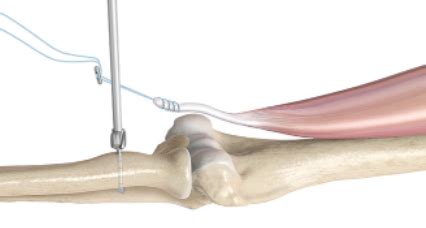 Distal Biceps Tendon Repair Repair The Biceps Tendon From The Elbow