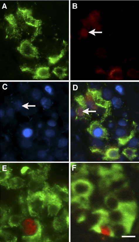 Expression Of Perinuclear And Nuclear Chop In Human Pancreatic