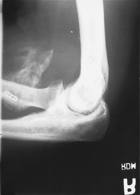 Case Report Heterotopic Ossification After Repair Of Distal Biceps