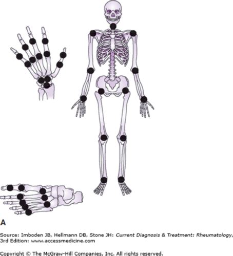 Rheumatoid Arthritis Flashcards Quizlet