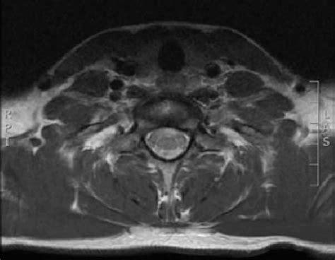 Contrast magnetic resonance imaging (MRI) of the cervical spine (axial ...