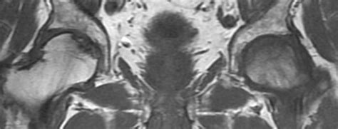 Bilateral Avascular Necrosis Of The Hip Image