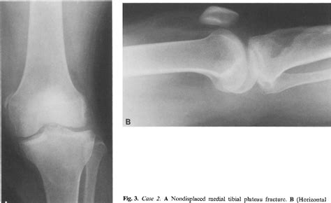 The Double Fat Fluid Level Lipohemarthrosis Of The Knee Associated With Suprapatellar Plica