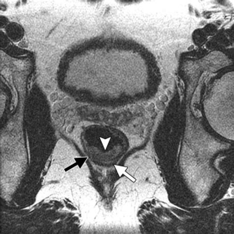 Drawing Illustrates Tumor Staging In Rectal Cancer Stage T1 Tumors Are