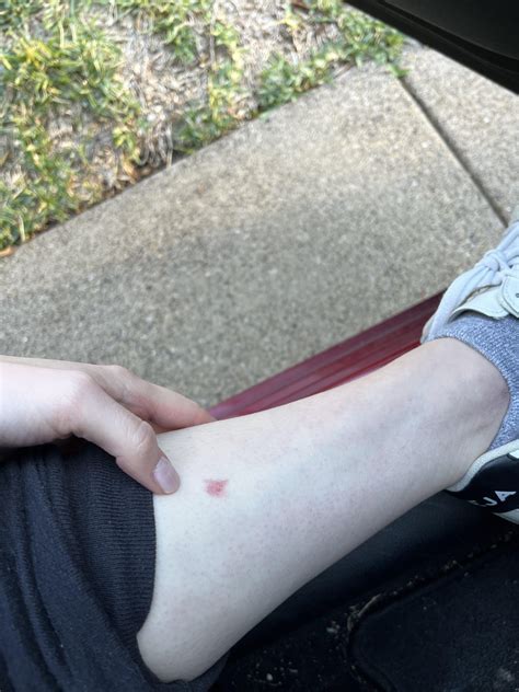 bite identification needed itchy  ive