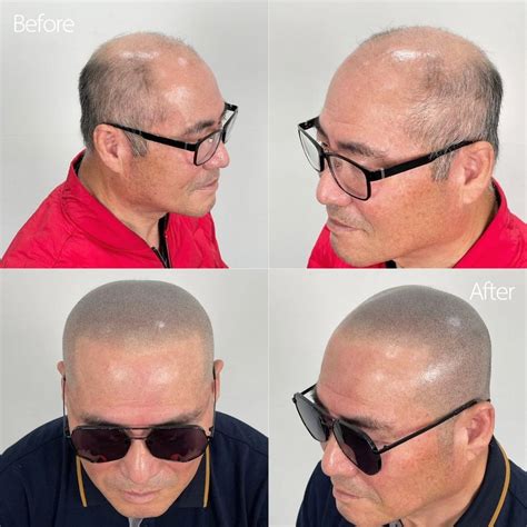 Next Smp Smp Scalp Micro Pigmentation 😎non Invasive Facebook