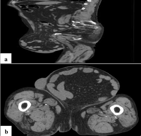 Progressive Preoperative Pneumoperitoneum In A Patient With Giant