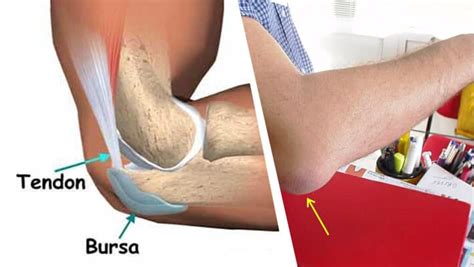 Qu Es La Bursitis Causas S Ntomas Y Tratamiento