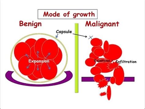 Differences Between Benign And Malignant Tumor Youtube