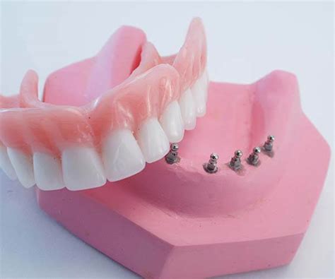 Clip On Dentures - Dental News Network