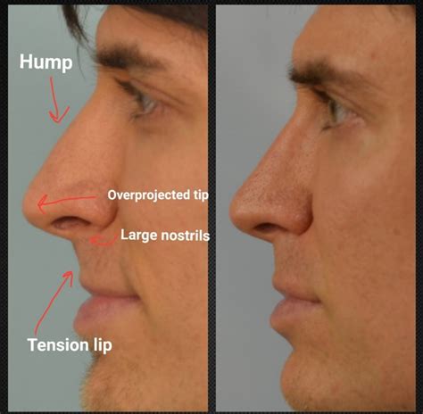 Male Rhinoplasty In Los Angeles Rhinoplasty Los Angeles Best Nose