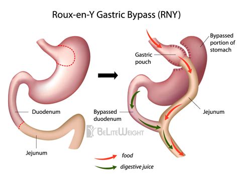 Lap Band Gastric Sleeve Bypass A History Of Weight Loss Surgery Beliteweight Weight Loss