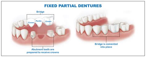 Fixed Partial Dentures Img 02 Modern Dental Clinic