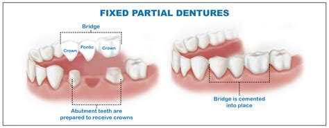 fixed-partial-dentures-img-02 - Modern Dental Clinic