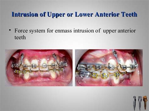 Orthodontic Miniscrew Implants