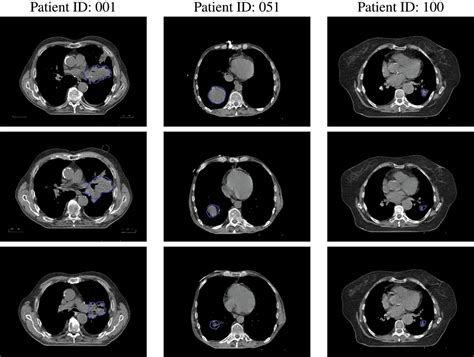 Figure 1 Evaluation Of Shape And Textural Features From Ct As