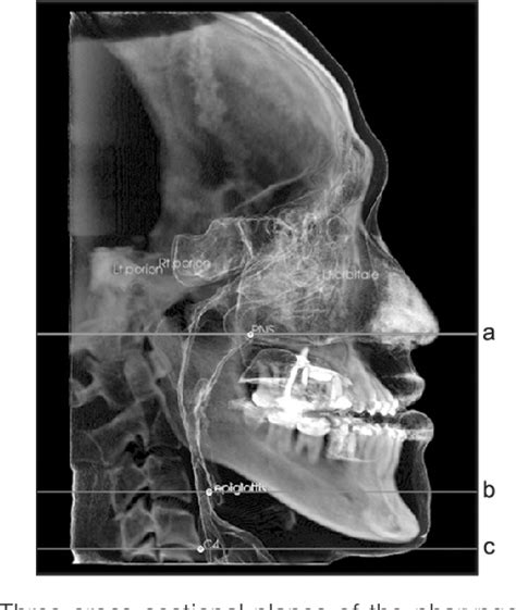 Figure From Three Dimensional Analysis Of Pharyngeal Airway Change Of