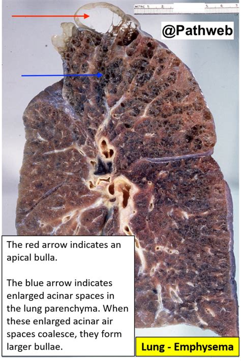 Lung Emphysema Nus Pathweb Nus Pathweb