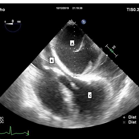 Subxiphoid Ultrasound Scan Showing A Large Partially Hyperechoic