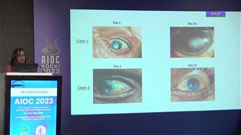 AIOC 2023 FP1120 Cornea II topic DR SUCHITRA KUMARI Use of topical ...