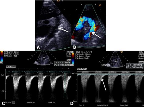 Coarctation Of The Aorta Thoracic Key