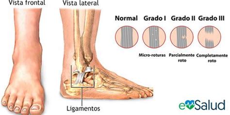 Distintos Grados Del Esguince De Tobillo Sprained Ankle