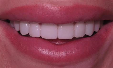 Cosmetic Dentistry Edina Mn Before And After Results