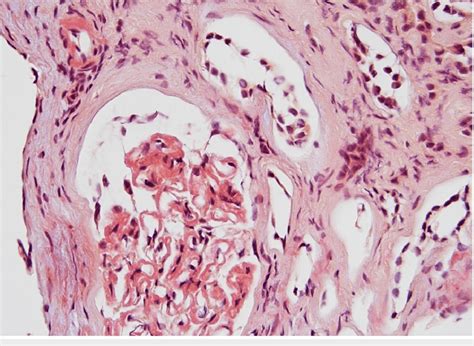 Congo Red Staining Of Glomerulus The Blood Vessel Frozen Section