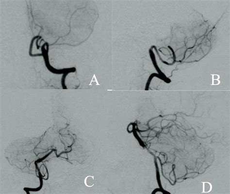 (A) and (B). Left vertebral artery imaging showing the vertebral artery ...