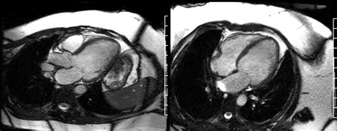 Invisible Cardiac Lesion Society For Cardiovascular Magnetic Resonance