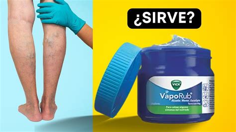 Vick Vaporub en las varices Qué tanto sirve Es bueno aplicarlo