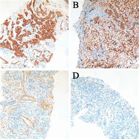 Kaplanmeier Survival Analysis Of Met Expression In Advanced Lung