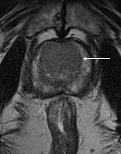 Transition Zone Tumor A 54 Year Old Male With Biopsy Confirmed Gleason