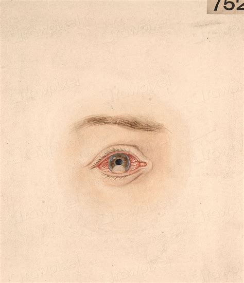 eye showing dislocation lens anterior  photo illustration rawpixel