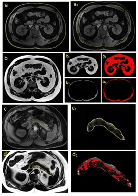 Water And Fat Content Segmentation Of Subcutaneous Adipose Tissue