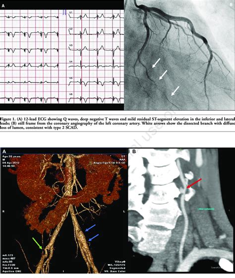 A D Reconstruction Of Ct Angiography Of The Abdominal Arteries