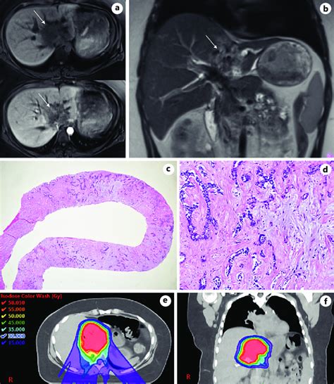 A B Magnetic Resonance Imaging Revealed A Poorly Defined T1