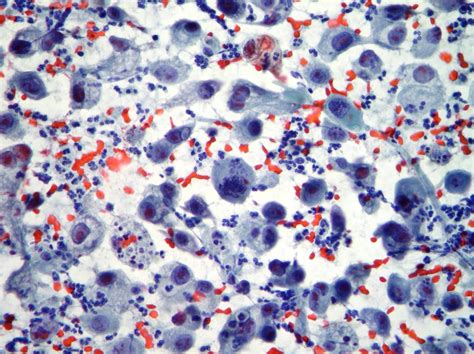 Diagnostic Cytopathology In Thyroid Pathology Differential Diagnosis