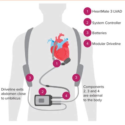 Basic Left Ventricular Assist Device Components Download Scientific