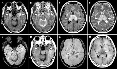 COVID 19associated Acute Hemorrhagic Necrotizing Encephalopathy