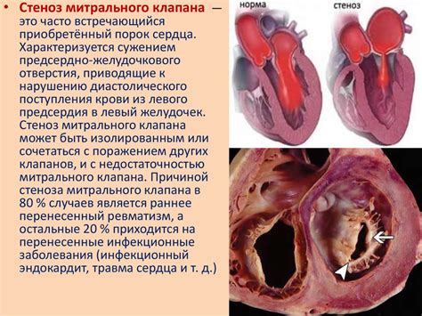 Врожденные пороки сердца - online presentation