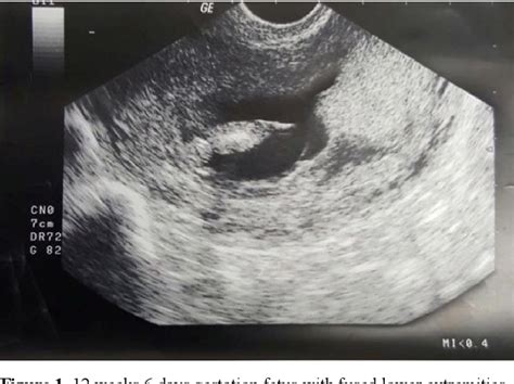 Figure From Prenatal Diagnosis Of Sirenomelia In The First Trimester