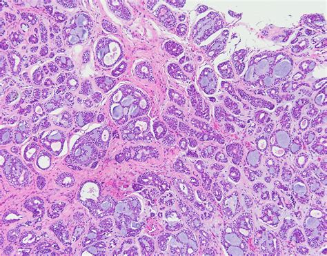 Adenoid Cystic Carcinoma Salivary Gland Global Pathology Teaching And