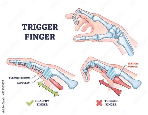 Trigger Finger As Finger Stuck In Bent Position Condition Outline