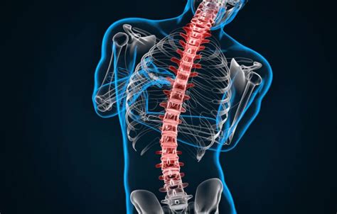 Escoliosis Idiopática En Niños Y Adolescentes Cecoten