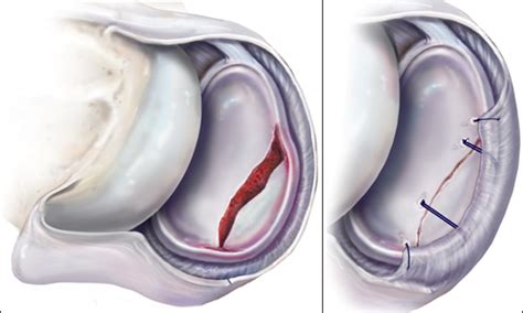 Bony Bankart Shoulder Instability | Shoulder Injuries | Dr. Christopher ...