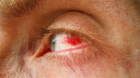 60 Subconjunctival Hemorrhage Stock Photos Pictures And Royalty Free